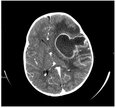 Brain Abscess as Severe Presentation of Specific Granule Deficiency